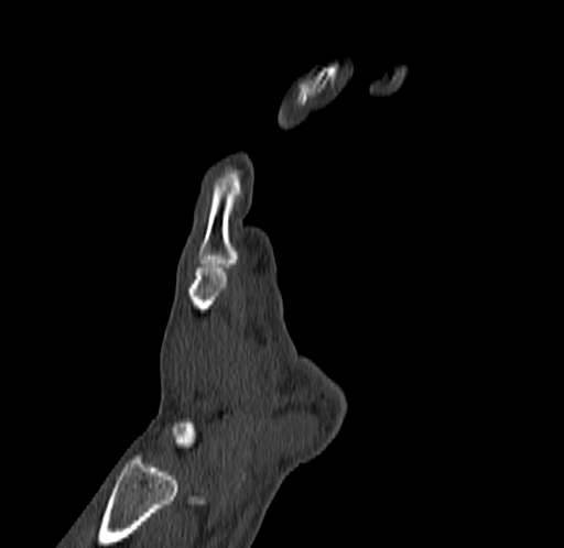 Base of 2nd metacarpal fracture (Radiopaedia 73741-84544 Coronal bone window 24).jpg