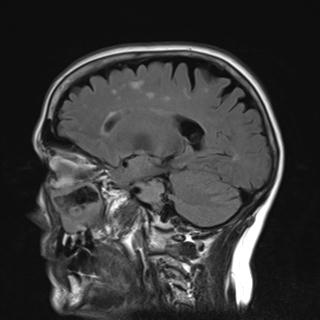 File:Base of skull chondrosarcoma (Radiopaedia 30410-31070 Sagittal FLAIR 7).jpg
