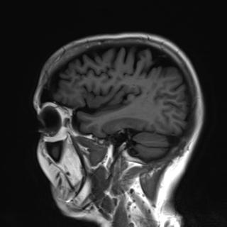 File:Base of skull chondrosarcoma (Radiopaedia 30410-31070 Sagittal T1 4).jpg