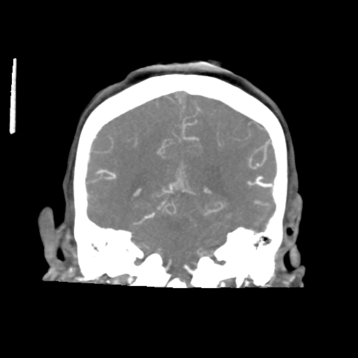 Basilar and bilateral vertebral artery occlusion (Radiopaedia 45592-49723 B 67).png