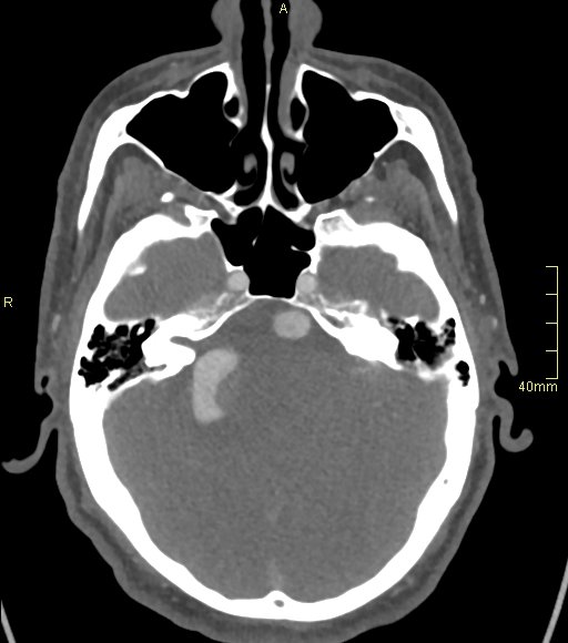 Basilar artery aneurysm (Radiopaedia 56261-62932 A 58).jpg