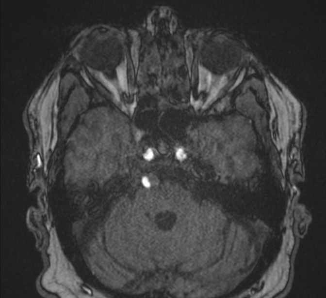 Basilar artery dissection (Radiopaedia 77032-88976 Axial TOF 57).jpg