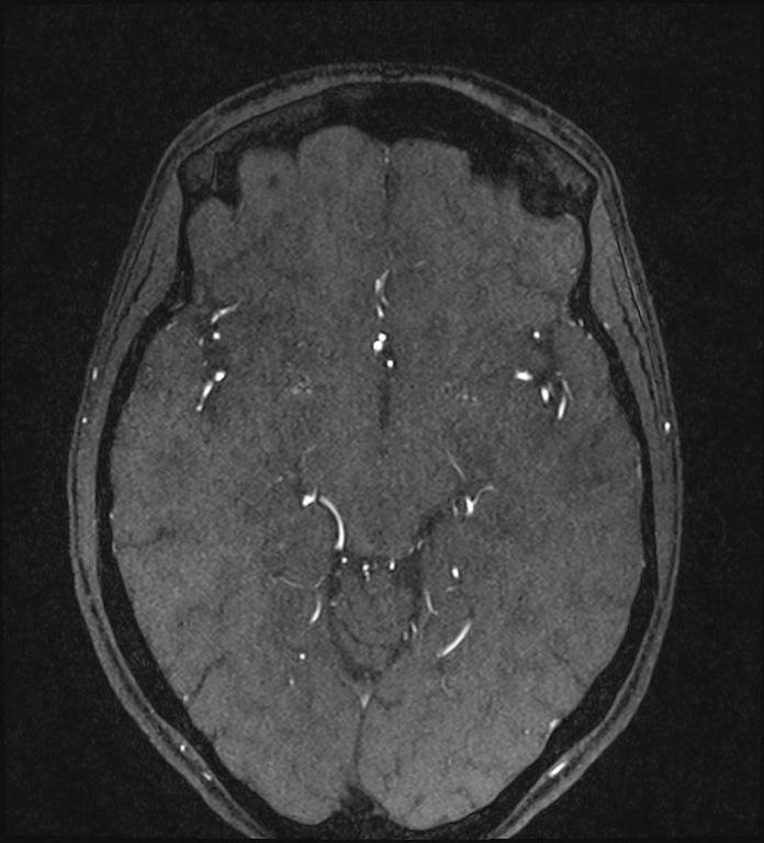 Basilar artery perforator aneurysm (Radiopaedia 82455-97733 Axial MRA 116).jpg
