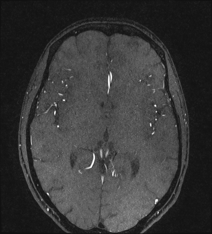 Basilar artery perforator aneurysm (Radiopaedia 82455-97733 Axial MRA 136).jpg