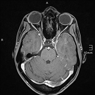 Basilar artery perforator aneurysm (Radiopaedia 82455-99523 G 44).jpg