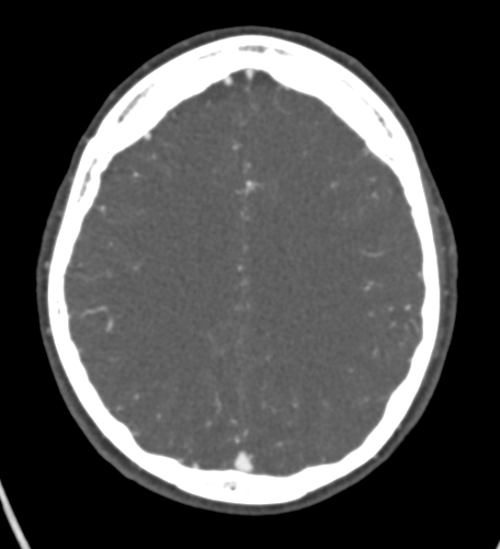 Basilar tip aneurysm with coiling (Radiopaedia 53912-60086 A 104).jpg