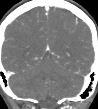 Basilar tip aneurysm with coiling (Radiopaedia 53912-60086 B 114).jpg
