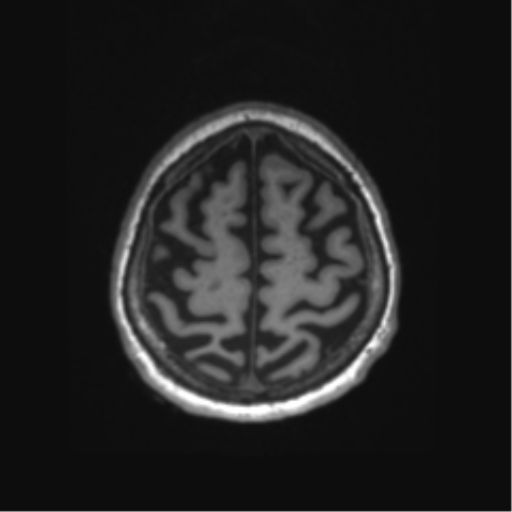 Behavioral variant frontotemporal dementia and late onset schizophrenia (Radiopaedia 52197-58083 Axial T1 7).png