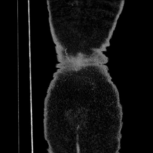 Benign leiomyoma with hydropic features (Radiopaedia 89250-106130 B 109).jpg