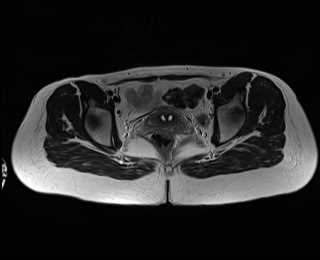 File:Bicornuate bicollis uterus (Radiopaedia 61626-69616 Axial T2 25).jpg