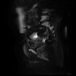 File:Bicornuate uterus (Radiopaedia 51676-57472 Sagittal DWI 36).jpg
