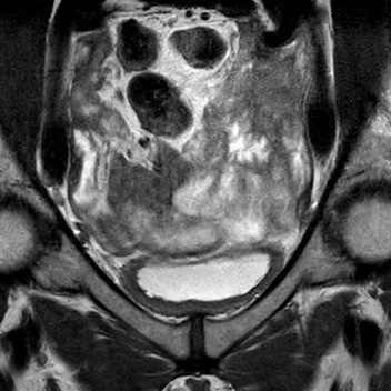 File:Bicornuate uterus (Radiopaedia 61974-70046 Coronal T2 2).jpg