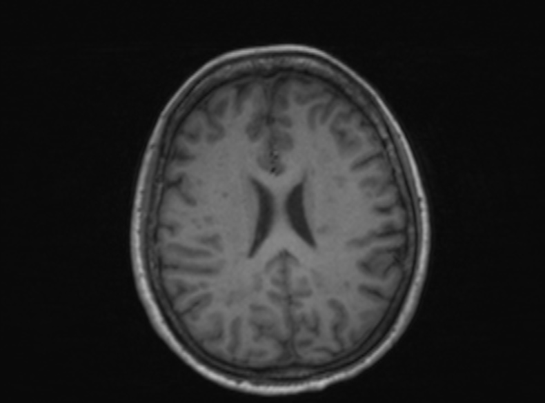 Bilateral PCA territory infarction - different ages (Radiopaedia 46200-51784 Axial T1 203).jpg