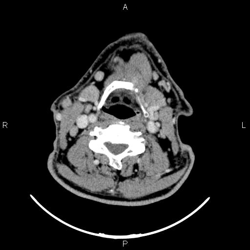 File:Bilateral Warthin tumors (Radiopaedia 84034-99263 Axial With contrast 38).jpg