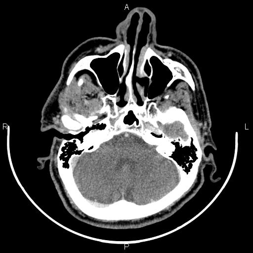 File:Bilateral Warthin tumors (Radiopaedia 84034-99263 Axial With contrast 7).jpg
