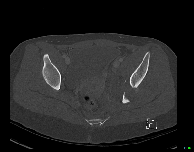 File:Bilateral acetabular fractures (Radiopaedia 79272-92308 Axial bone window 37).jpg