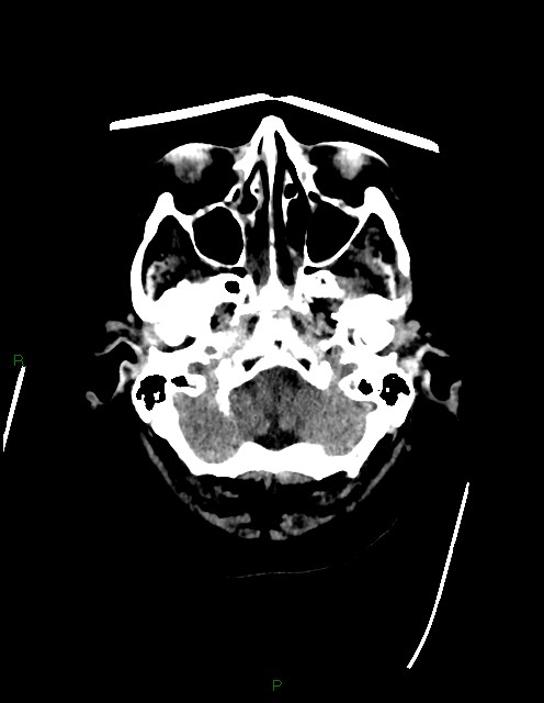 Bilateral acute middle cerebral artery territory infarcts (Radiopaedia 77319-89401 Axial non-contrast 10).jpg