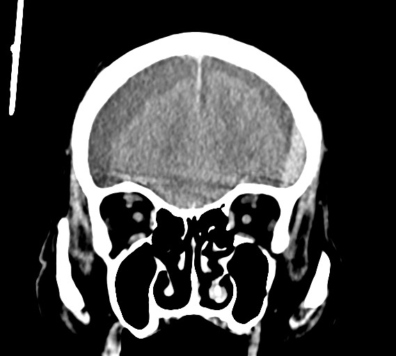 Bilateral acute on chronic subdural hematomas (Radiopaedia 78466-91146 Coronal non-contrast 19).jpg