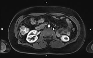 Bilateral adrenal myelolipoma (Radiopaedia 63058-71537 Axial T1 C+ fat sat 53).jpg