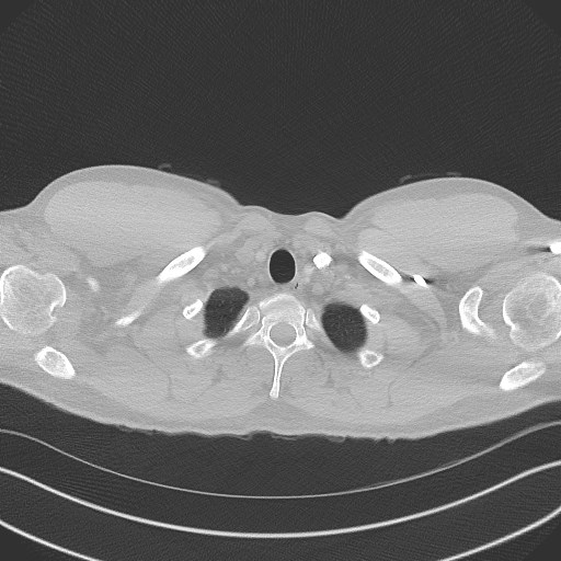 Bilateral atelectasis (Radiopaedia 48666-53675 Axial lung window 1).jpg