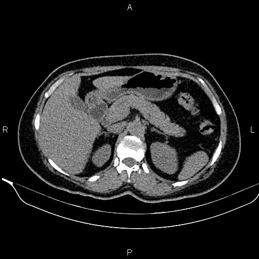 Bilateral benign adrenal adenomas (Radiopaedia 86912-103124 Axial non-contrast 38).jpg