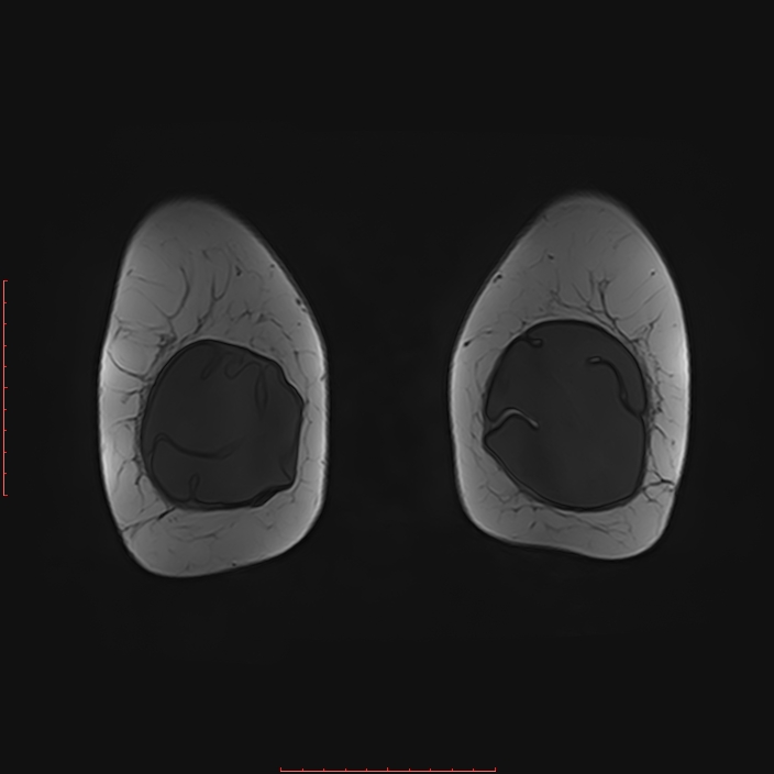 Bilateral breast implant rupture (Radiopaedia 24761-25027 G 89).jpg