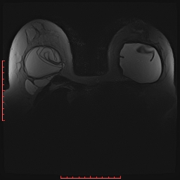 File:Bilateral breast implant rupture (Radiopaedia 24761-25027 PASTA Si 11).jpg