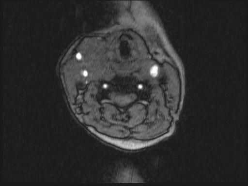 Bilateral carotid body tumors and right glomus jugulare tumor (Radiopaedia 20024-20060 Axial MRA 246).jpg