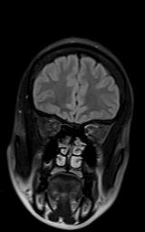 File:Bilateral carotid body tumors and right jugular paraganglioma (Radiopaedia 20024-20060 Coronal 71).jpg