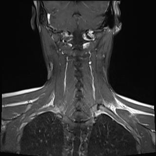 File:Bilateral carotid body tumors and right jugular paraganglioma (Radiopaedia 20024-20060 None 16).jpg