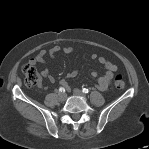 File:Bilateral delayed nephrogram from renal artery stenosis (Radiopaedia 47681-52362 A 42).png