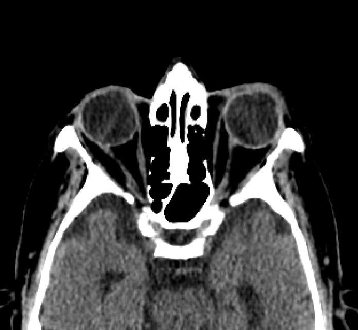 Bilateral ectopia lentis (Radiopaedia 89889-107013 Axial non-contrast 40).jpg