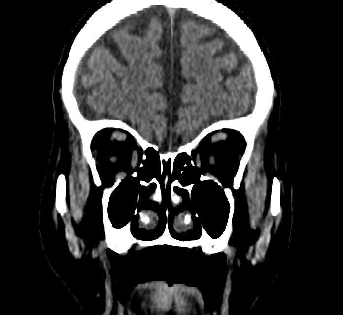 Bilateral ectopia lentis (Radiopaedia 89889-107013 Coronal non-contrast 67).jpg