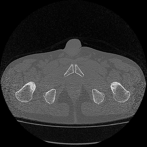 Bilateral femoral neck stress fractures (Radiopaedia 28666-28954 Axial bone window 67).png