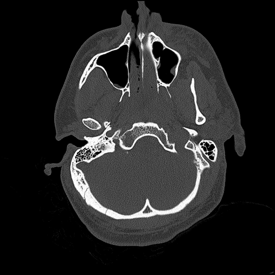 Bilateral occipital condyle fracture (type 2) (Radiopaedia 87675-104089 Axial bone thins 39).jpg