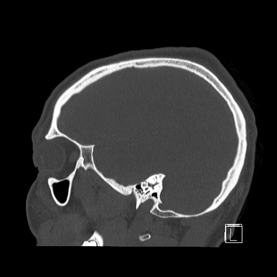 Bilateral occipital condyle fracture (type 2) (Radiopaedia 87675-104089 Sagittal bone window 89).jpg