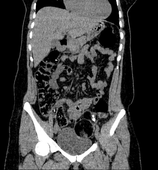 File:Bilateral ovarian dermoid (Radiopaedia 45714-49907 Coronal non-contrast 2).jpg