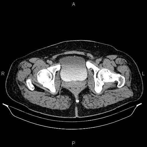 Bilateral ovarian dermoid cysts (Radiopaedia 85785-101603 Axial C+ delayed 85).jpg