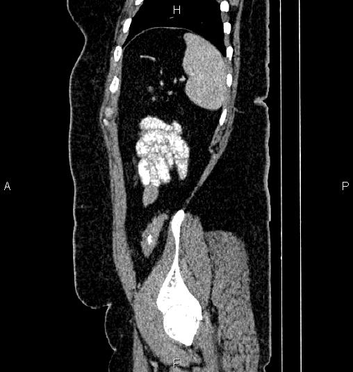 Bilateral ovarian dermoid cysts (Radiopaedia 85785-101603 D 81).jpg
