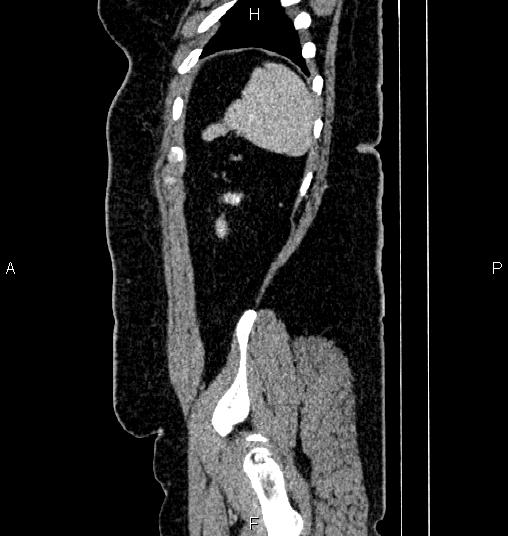File:Bilateral ovarian dermoid cysts (Radiopaedia 85785-101603 D 85).jpg