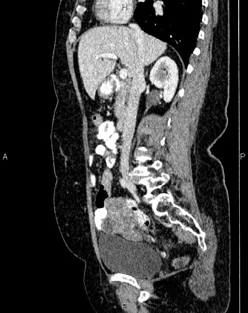 Bilateral ovarian serous cystadenocarcinoma (Radiopaedia 86062-101989 E 32).jpg