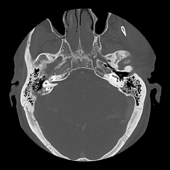 Bilateral perched facets with cord injury (Radiopaedia 45587-49713 Axial bone window 5).jpg