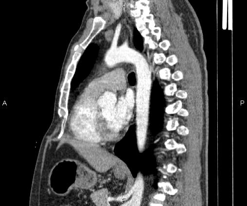 Bilateral pulmonary AVM (Radiopaedia 83134-97505 D 66).jpg
