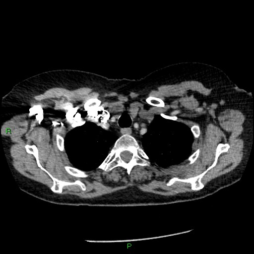 Bilateral pulmonary emboli (Radiopaedia 32700-33669 Axial C+ CTPA 12).jpg