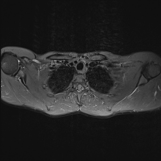 File:Bilateral spinoglenoid notch ganglion cysts (Radiopaedia 29577-30082 Axial STIR 18).jpg