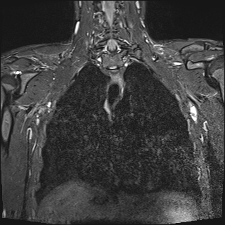 File:Bilateral spinoglenoid notch ganglion cysts (Radiopaedia 29577-30082 Coronal STIR 15).jpg