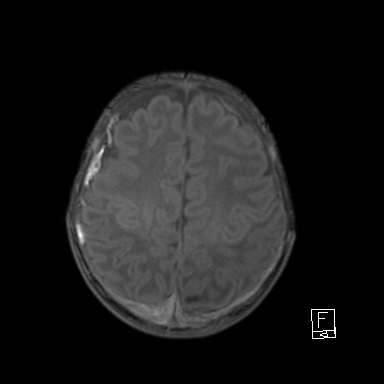 File:Bilateral subdural hemorrhage and parietal skull fracture (Radiopaedia 26058-26190 Axial T1 40).png