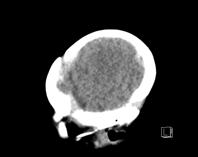 File:Bilateral subdural hemorrhage and parietal skull fracture (Radiopaedia 26058-26192 C 3).png