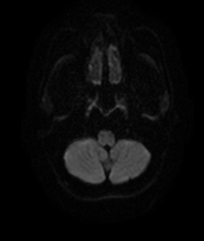 File:Bilateral thalamic gliomata (Radiopaedia 42538-45664 Axial DWI 4).jpg