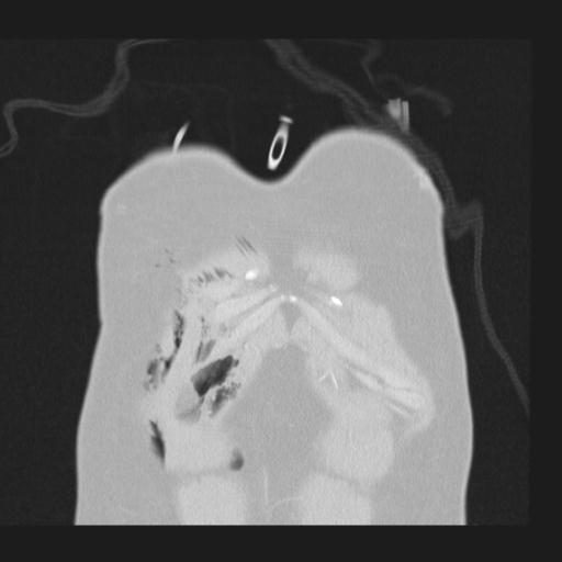 Bilateral traumatic renovascular injury (Radiopaedia 32051-32995 Coronal lung window 4).jpg
